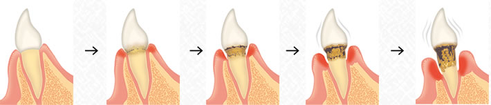 歯周病進行の流れ